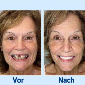 BENDCHARGE™🦷 - Premium-Zahnprothese