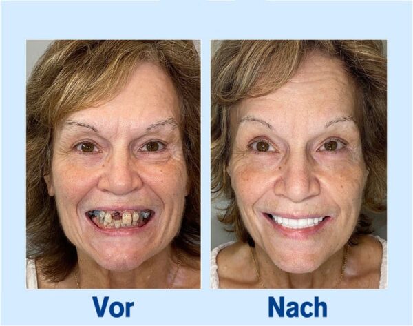 BENDCHARGE™🦷 - Premium-Zahnprothese